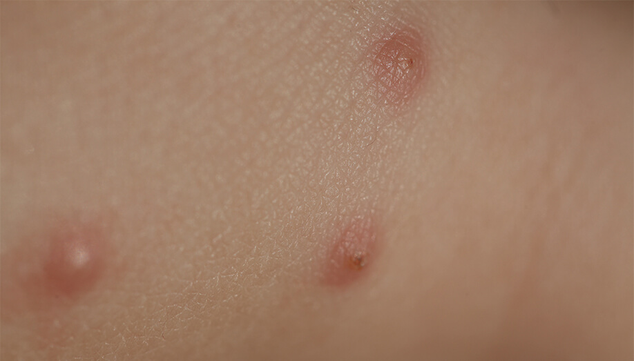 Identifying Common Insect Bites And Stings Sentinel Blog