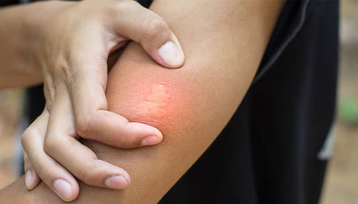 Stinging insect sting