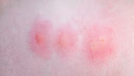 Mosquito bites