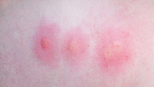 Mosquito bites