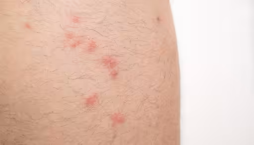 Flea bites