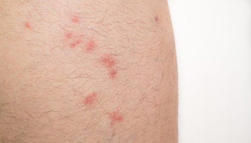Flea bites