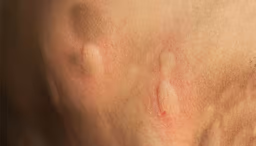 Spider bites