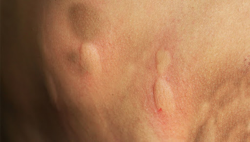 Spider bites