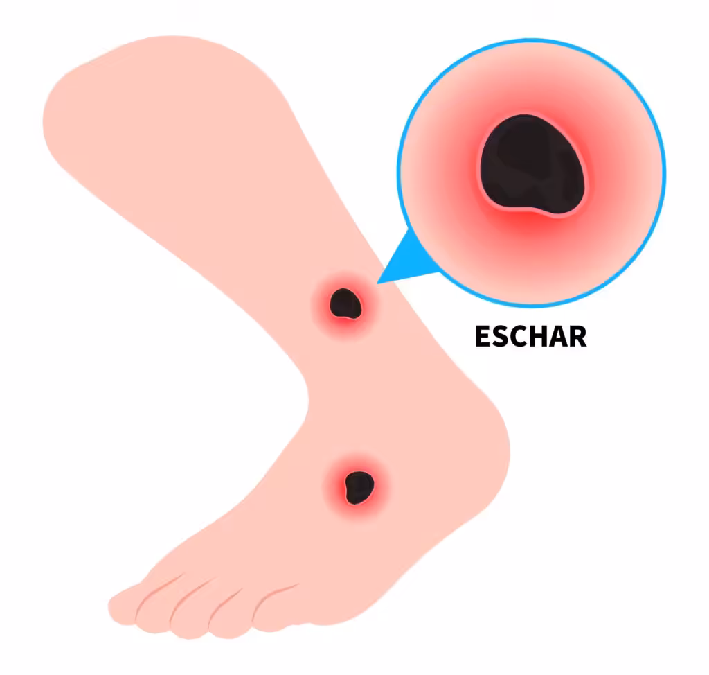 Black widow eschar after bite