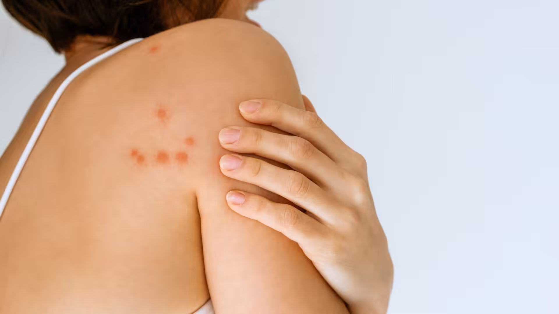 Bed bug bites