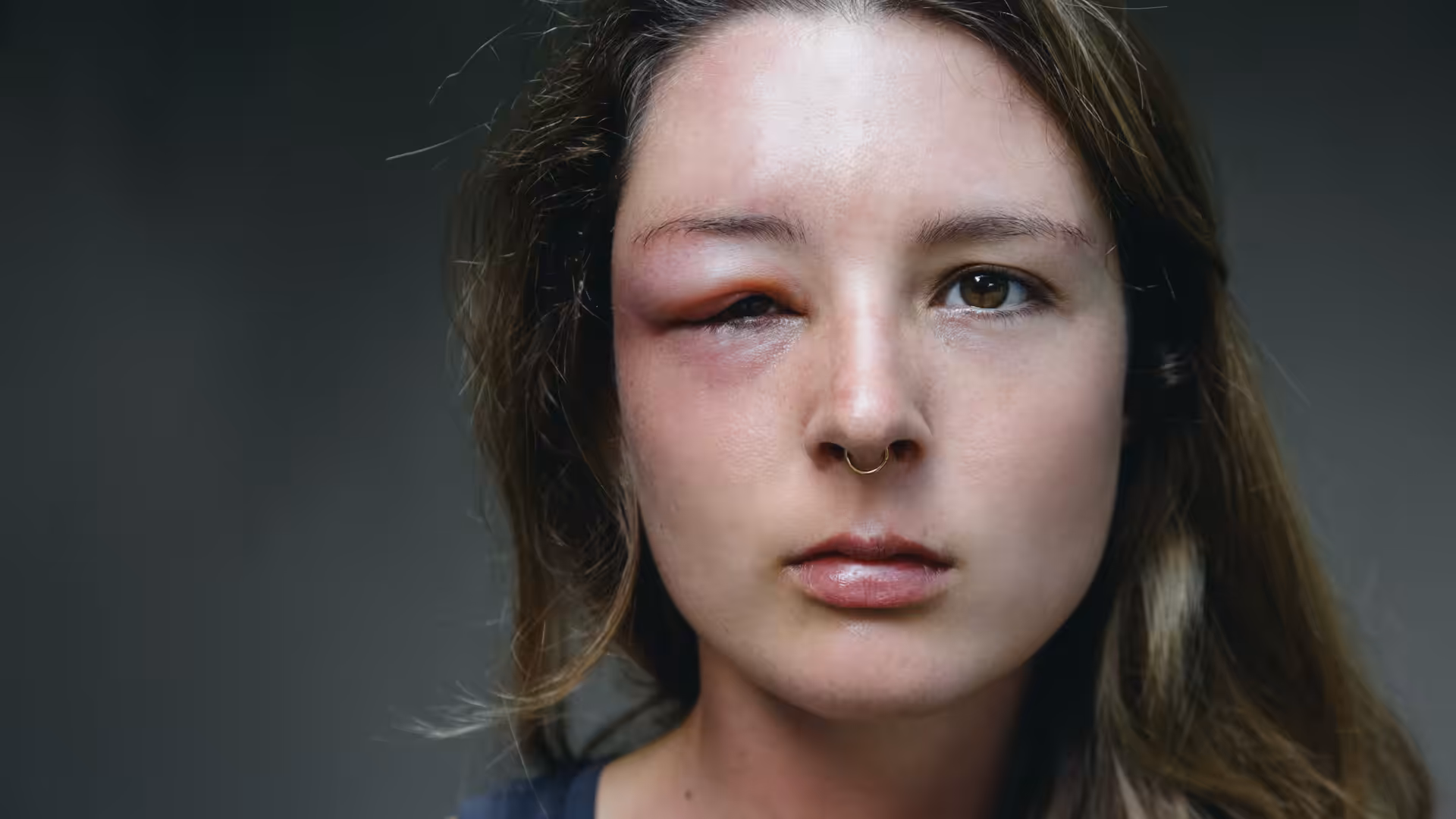 Allergic reaction to yellow jacket sting
