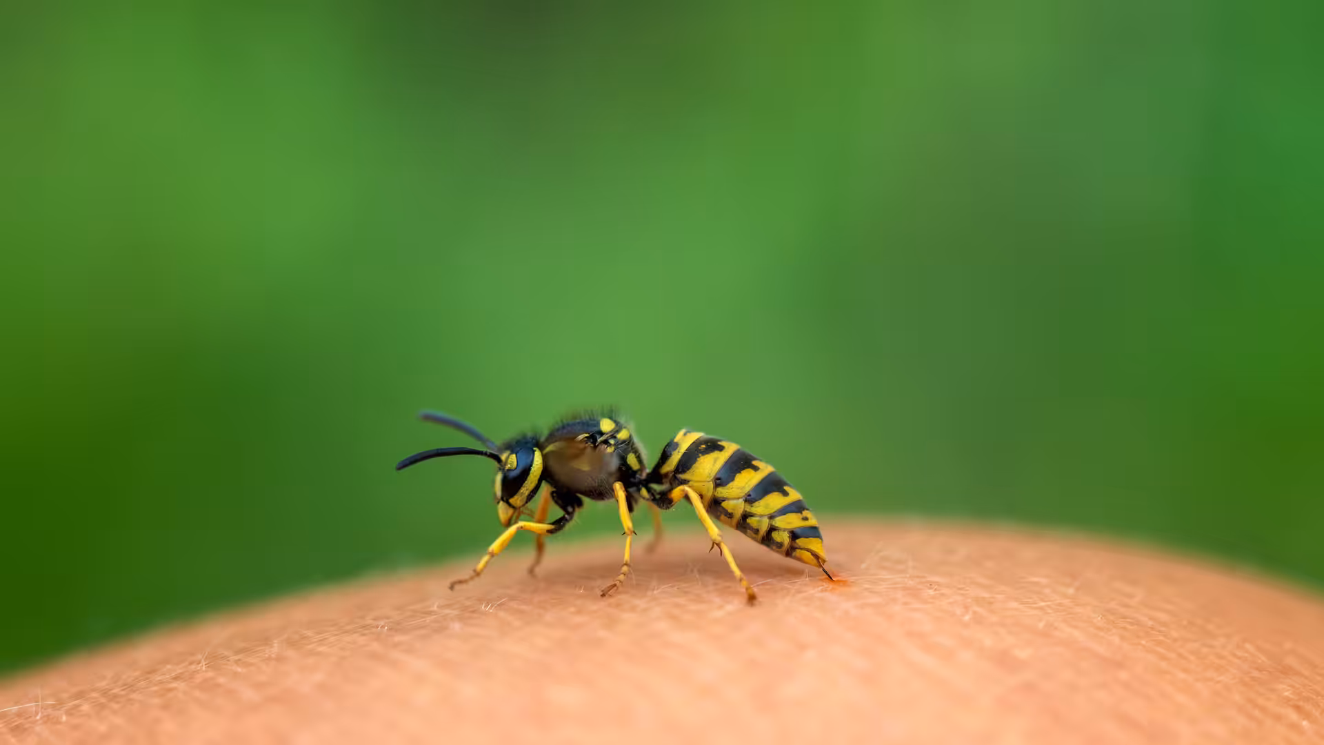 Multiple yellow jacket stings